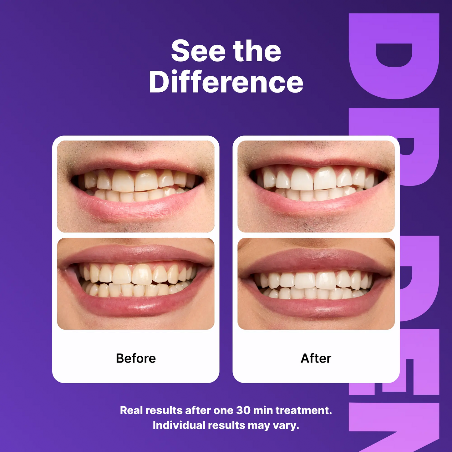 Purple Teeth Whitening Strips - 7/21 Whitening Sessions - Non Sensitive Teeth Whitening - Peroxide-Free